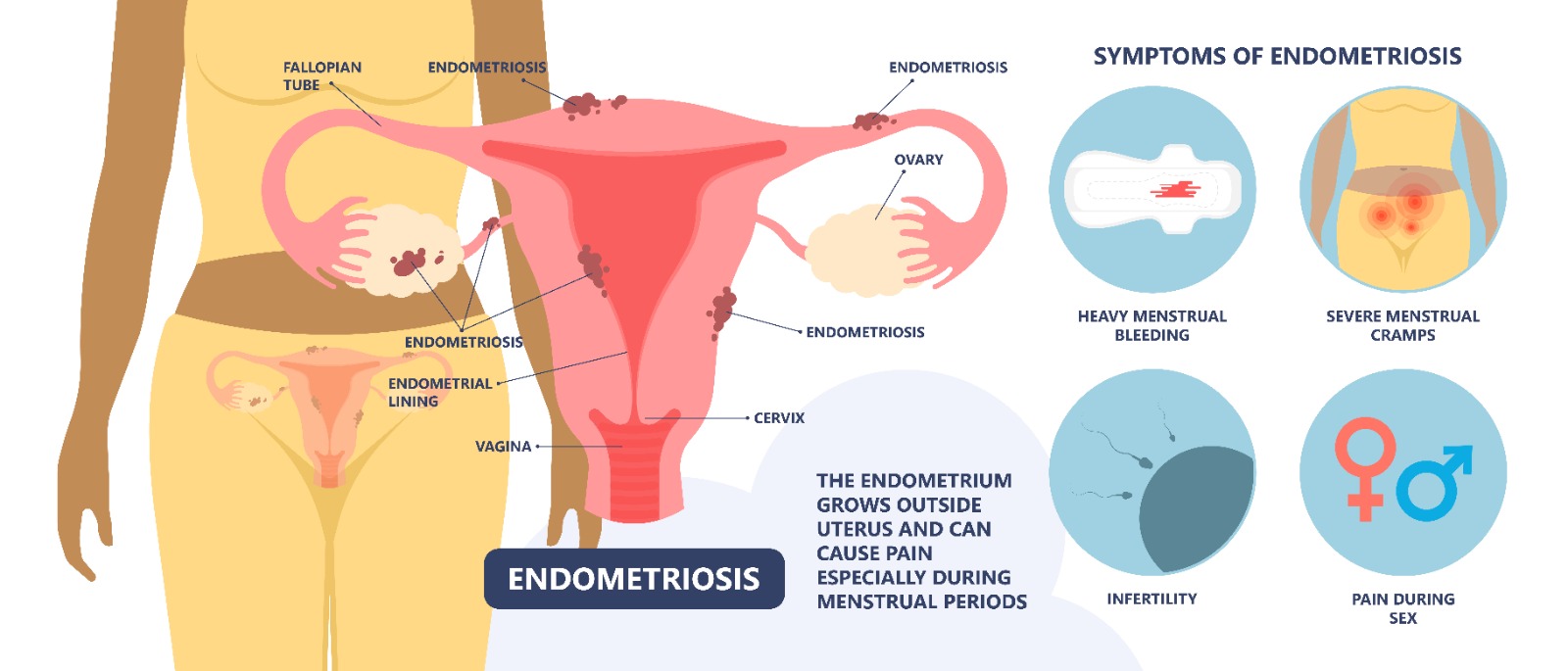 Understanding Endometriosis Causes, Symptoms, and Treatment